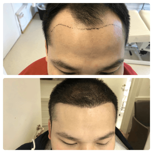 Före och efter – patient 1