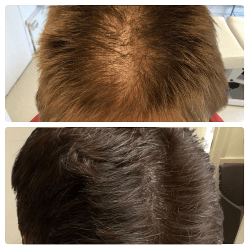 Före och efter – patient 2