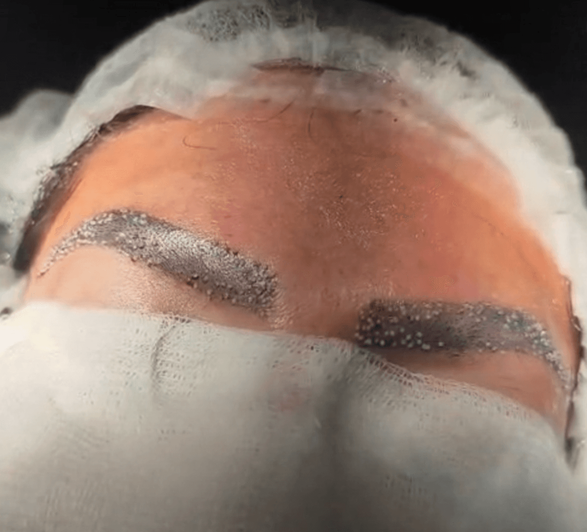 FUE behandling – procedur