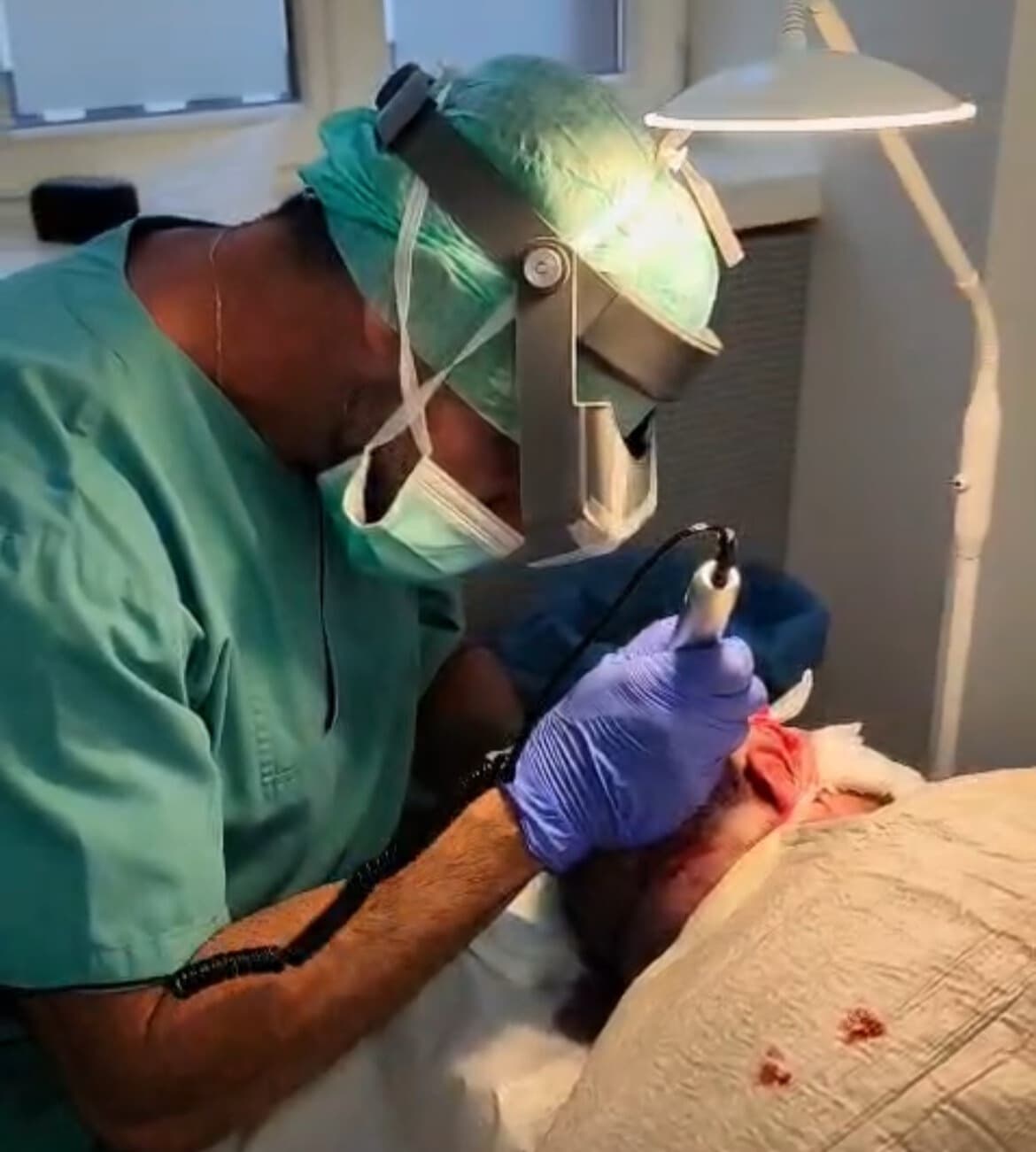 FUE implantation av grafts