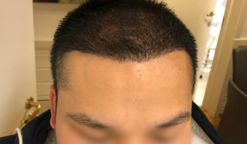 Efter hårtransplantation – patient 1