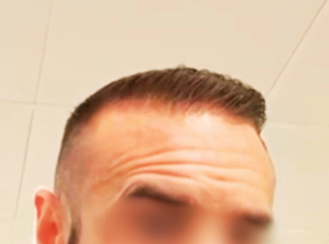 Efter hårtransplantation – patient 2, bild 1