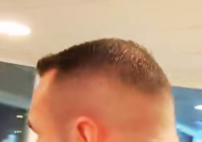 Efter hårtransplantation – patient 2, bild 2