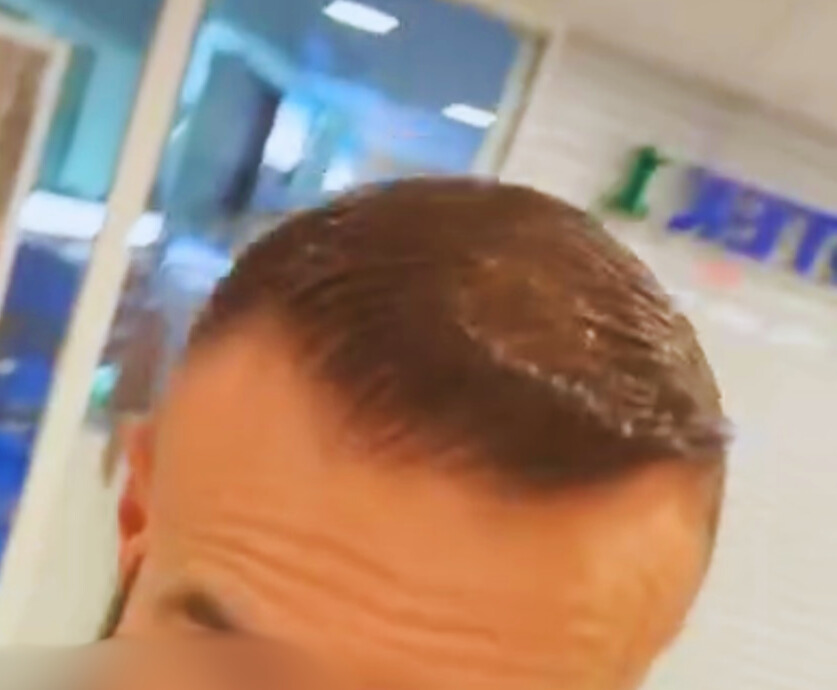 Efter hårtransplantation – patient 2, bild 3