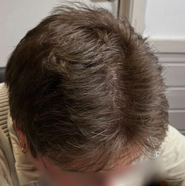 Efter hårtransplantation – patient 3