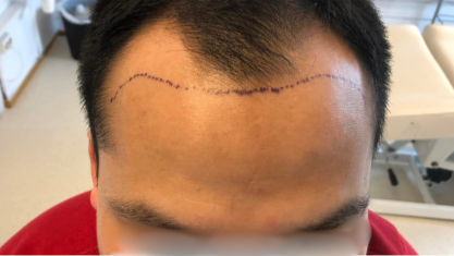 Före hårtransplantation – patient 1