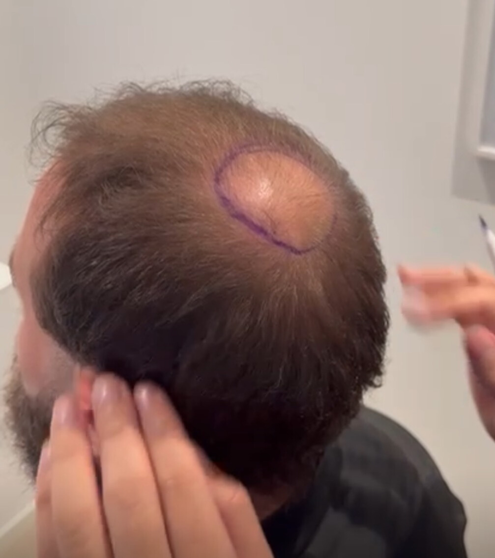 Före hårtransplantation – patient 2, bild 1