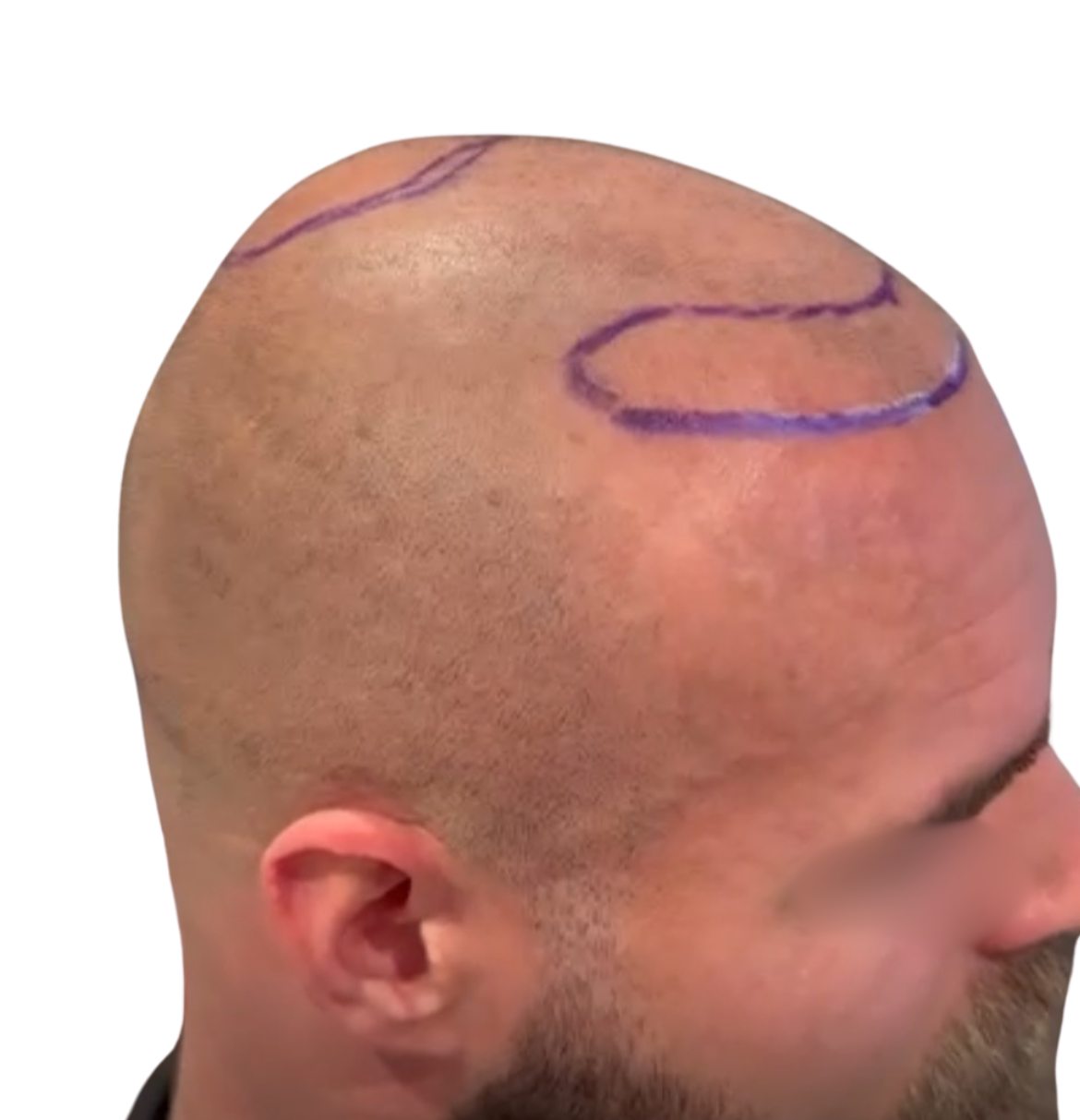 Före hårtransplantation – patient 2, bild 2