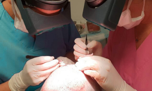 FUE-behandling pågår