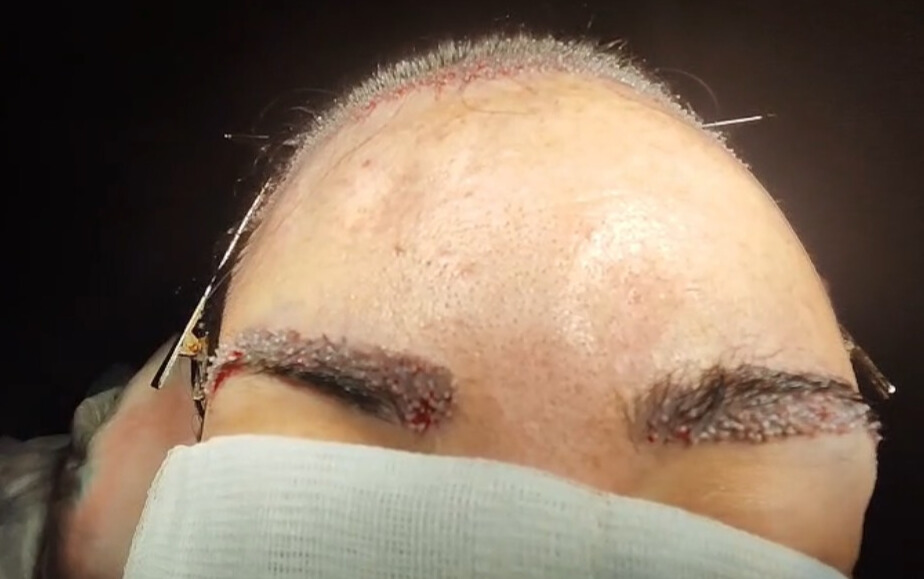 Hårtransplantation – resultat efter ingrepp