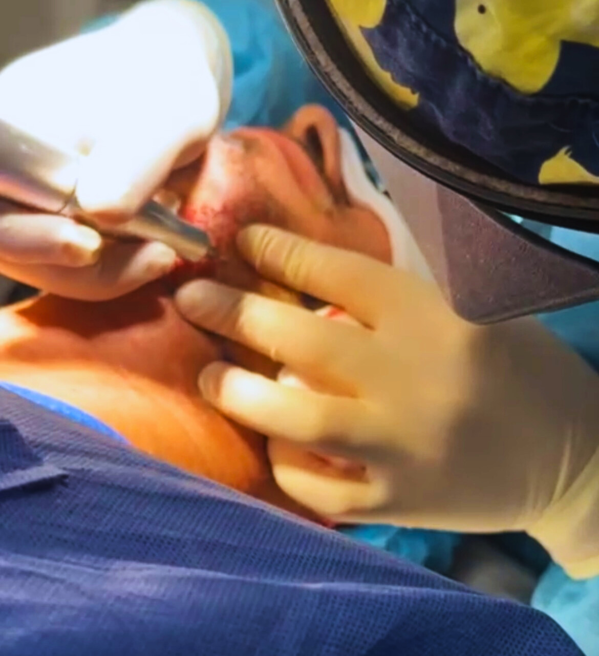 Närbild på hårtransplantation